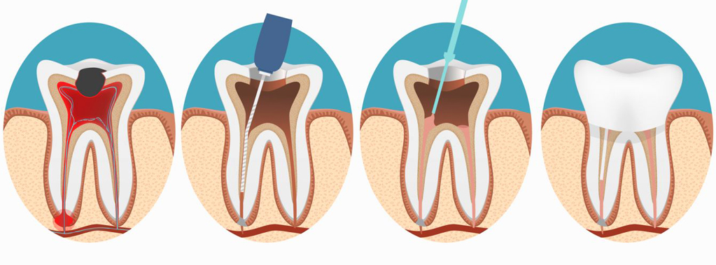 endododoncija